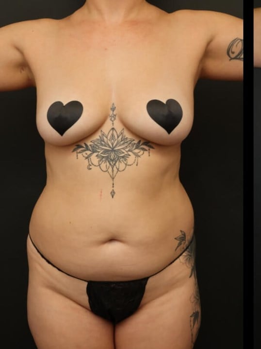 Neck Lipo, Lipo 360, Neck Lipo Before