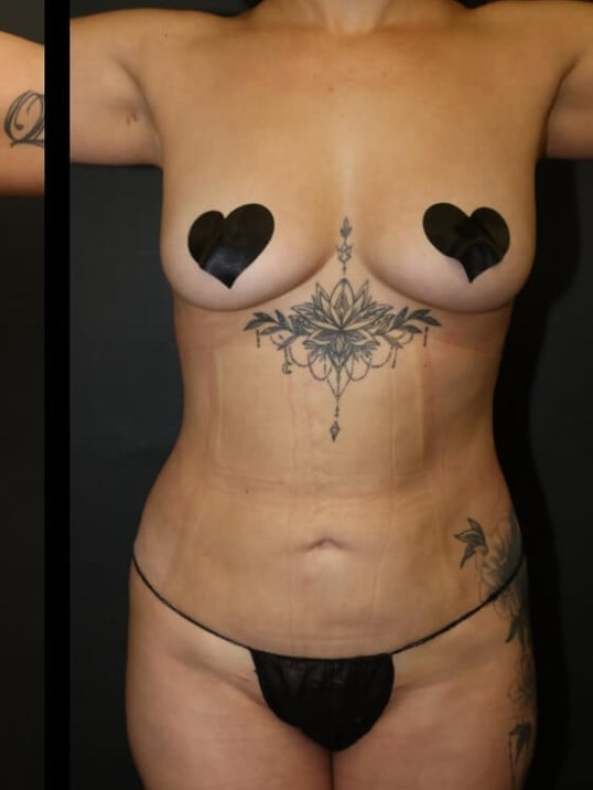 Neck Lipo, Lipo 360, Neck Lipo After