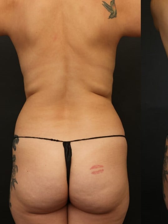 Neck Lipo, Lipo 360, Neck Lipo Before