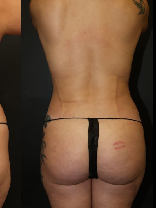 Neck Lipo, Lipo 360, Neck Lipo After