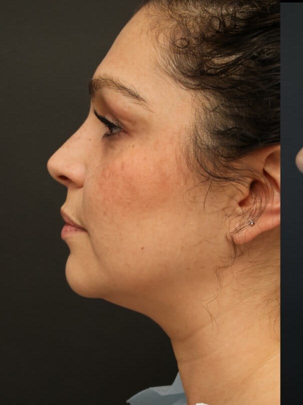 Neck Lipo, Lipo 360, Neck Lipo Before