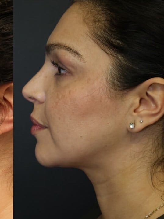 Neck Lipo, Lipo 360, Neck Lipo After