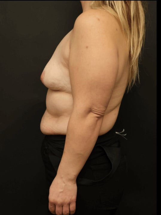 Breast Lift Before