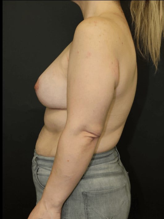 Breast Lift After