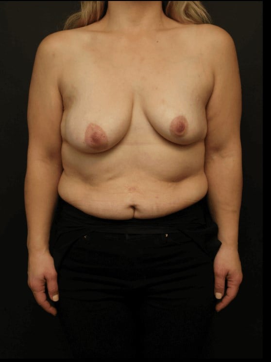 Breast Lift Before