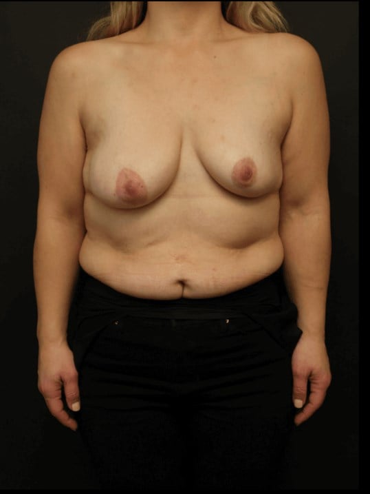 Breast Lift Before