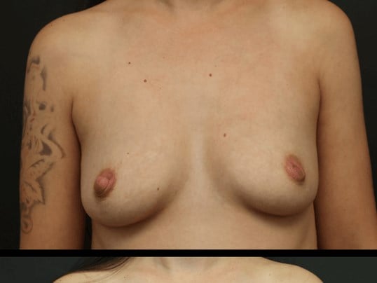 Breast Augmentation Before