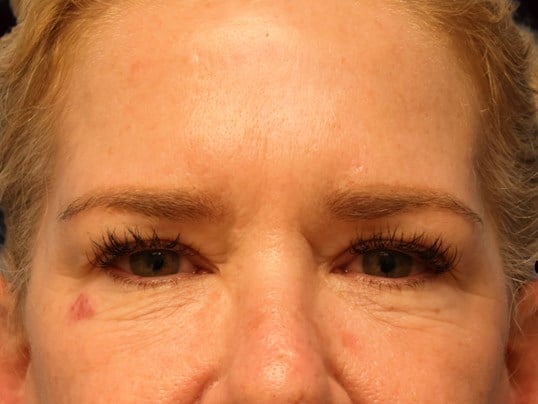 Upper and Lower Eye Bleph Before