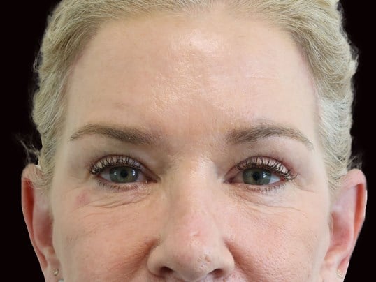 Upper and Lower Eye Bleph After