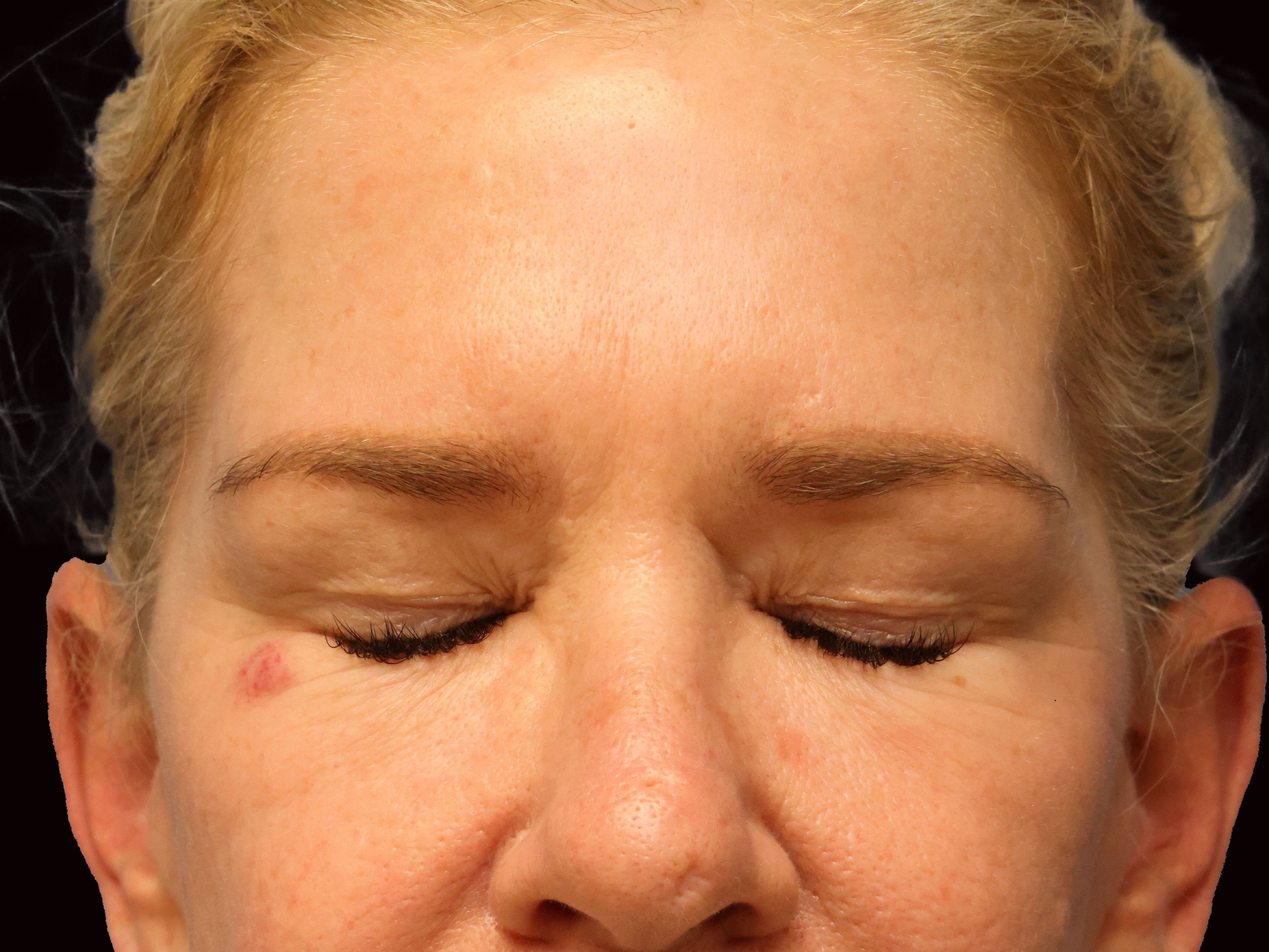 Upper and Lower Eye Bleph Before