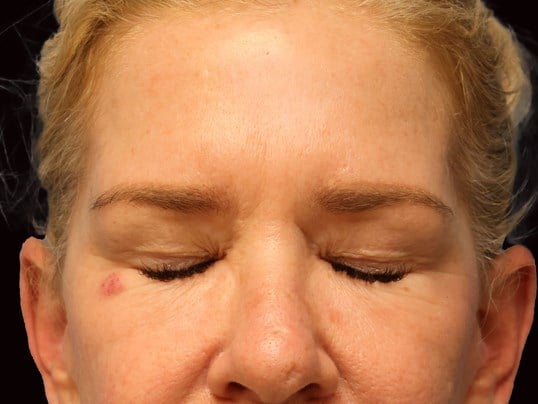 Upper and Lower Eye Bleph Before