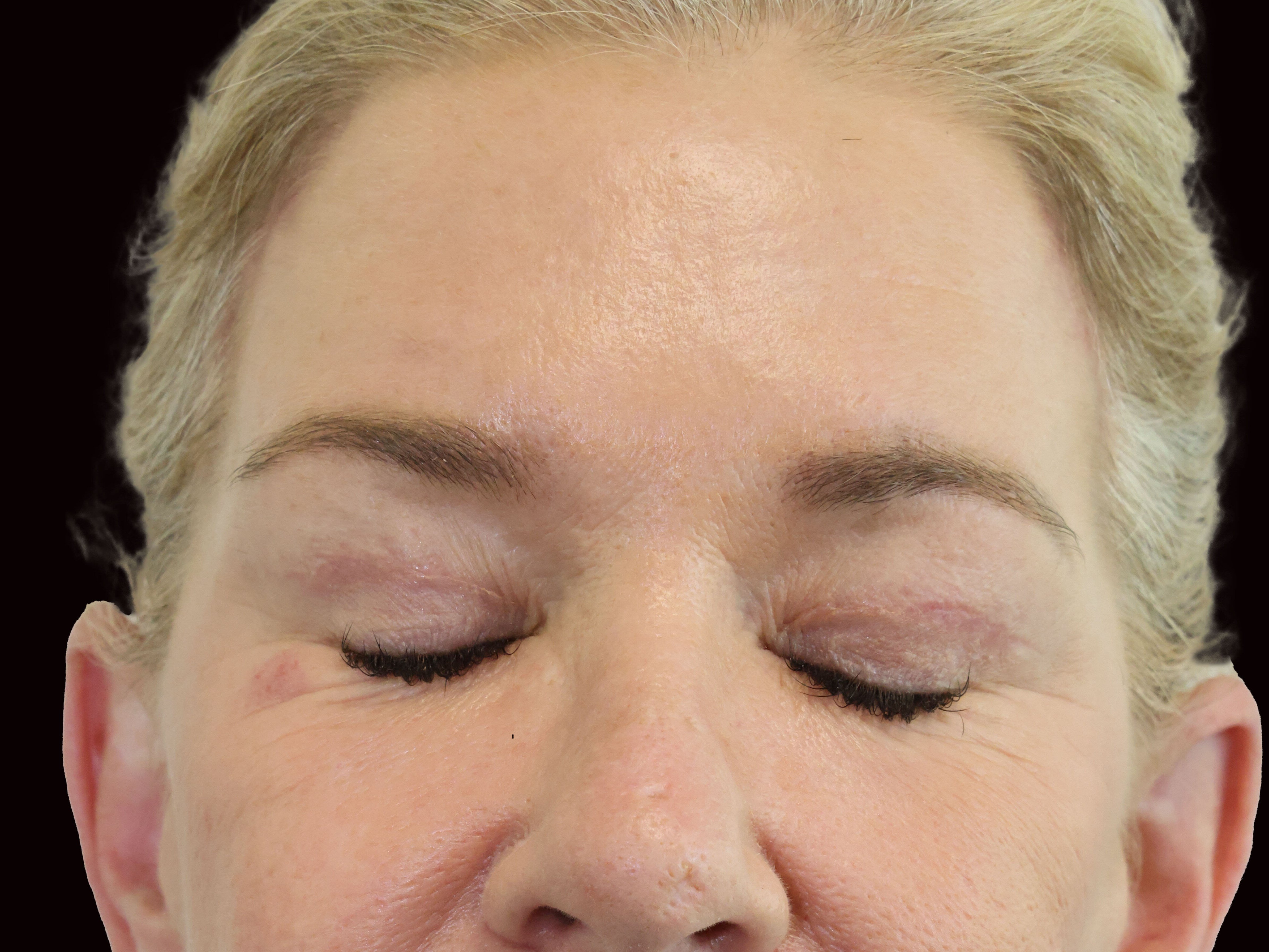 Upper and Lower Eye Bleph After