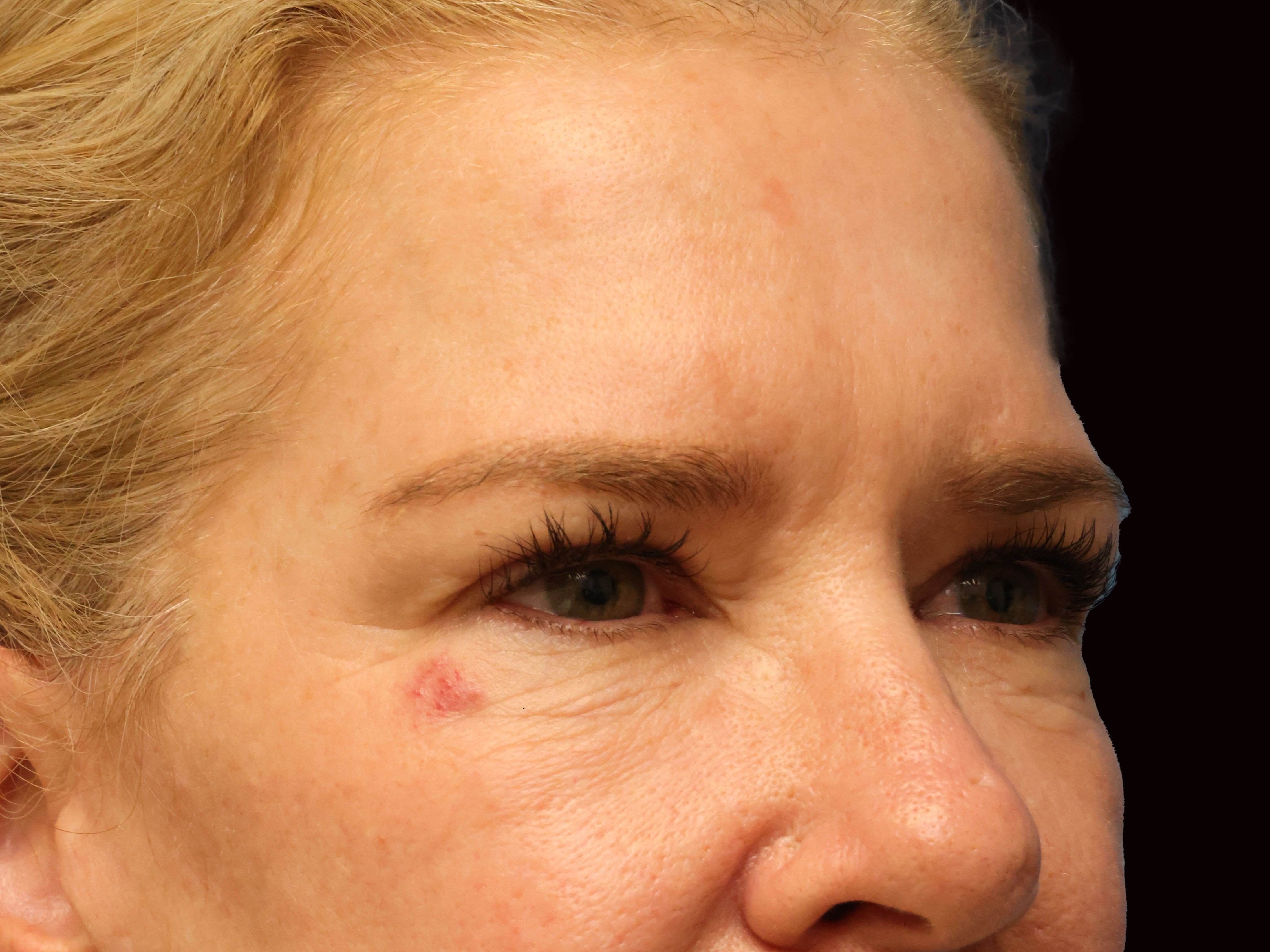 Upper and Lower Eye Bleph Before