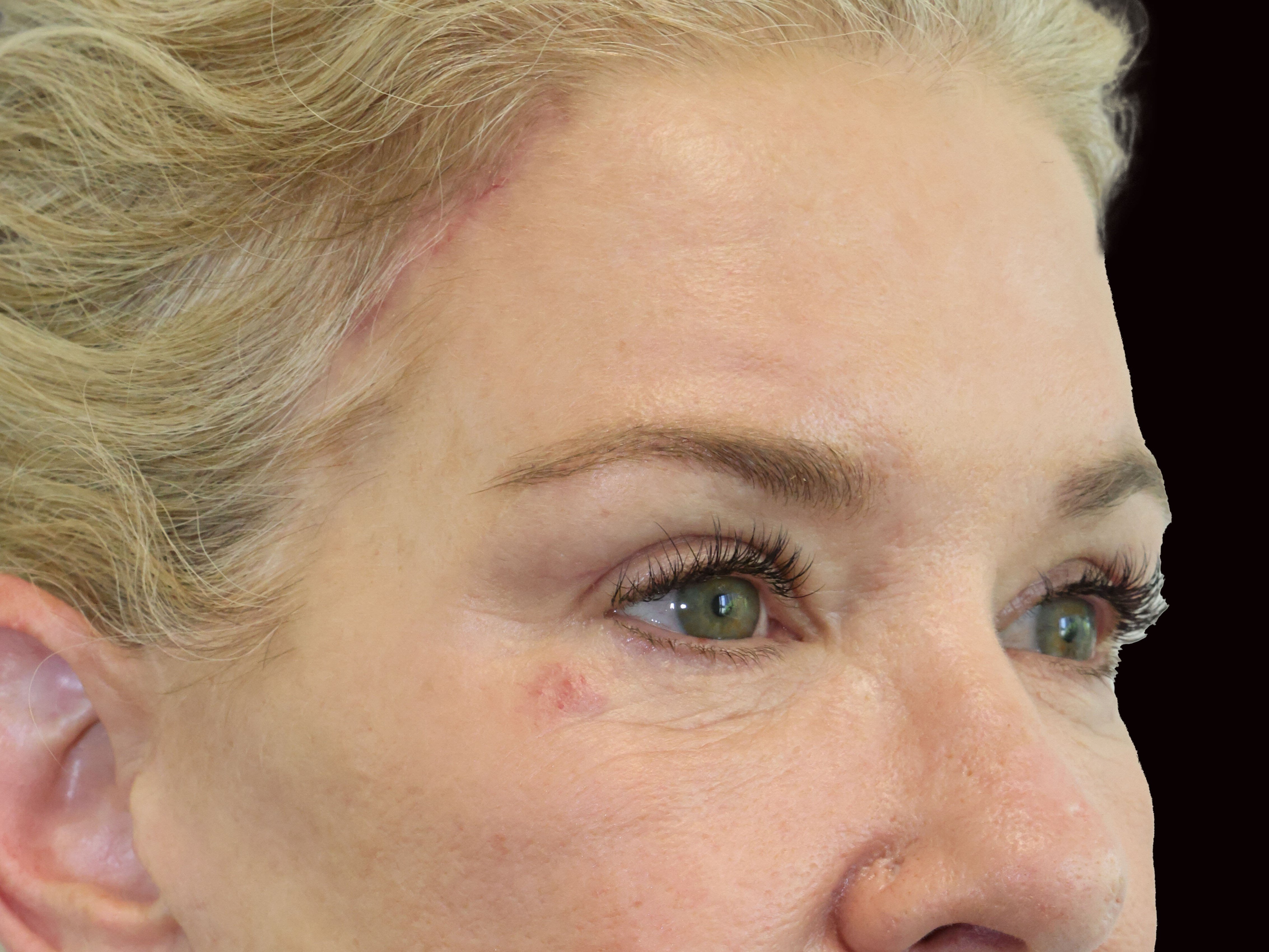 Upper and Lower Eye Bleph After