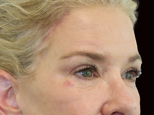 Upper and Lower Eye Bleph After