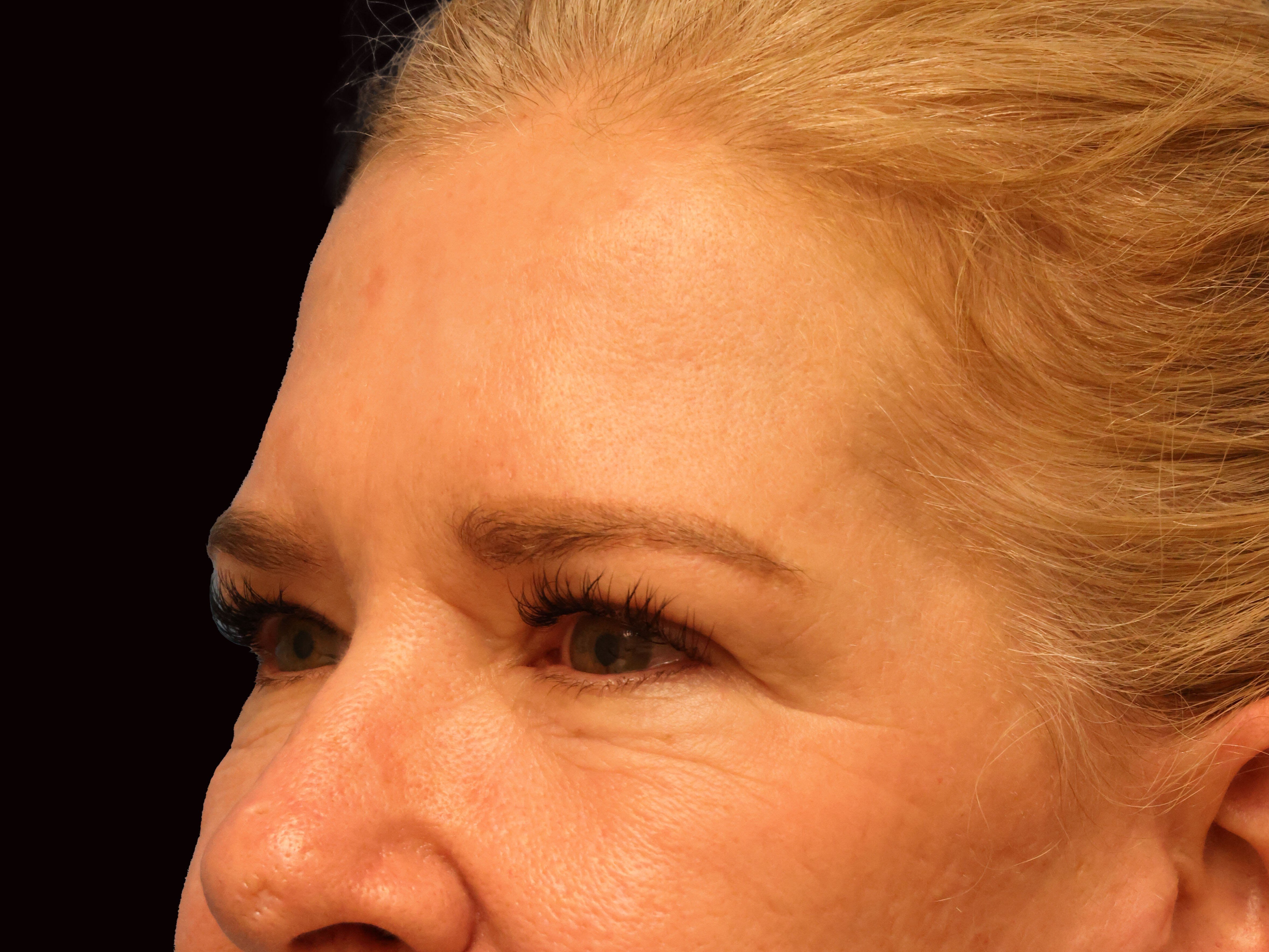 Upper and Lower Eye Bleph Before