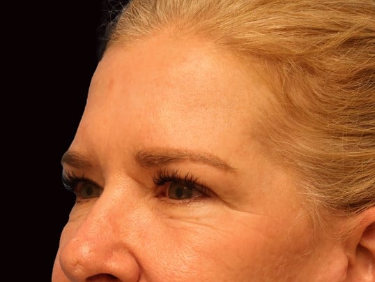 Upper and Lower Eye Bleph Before