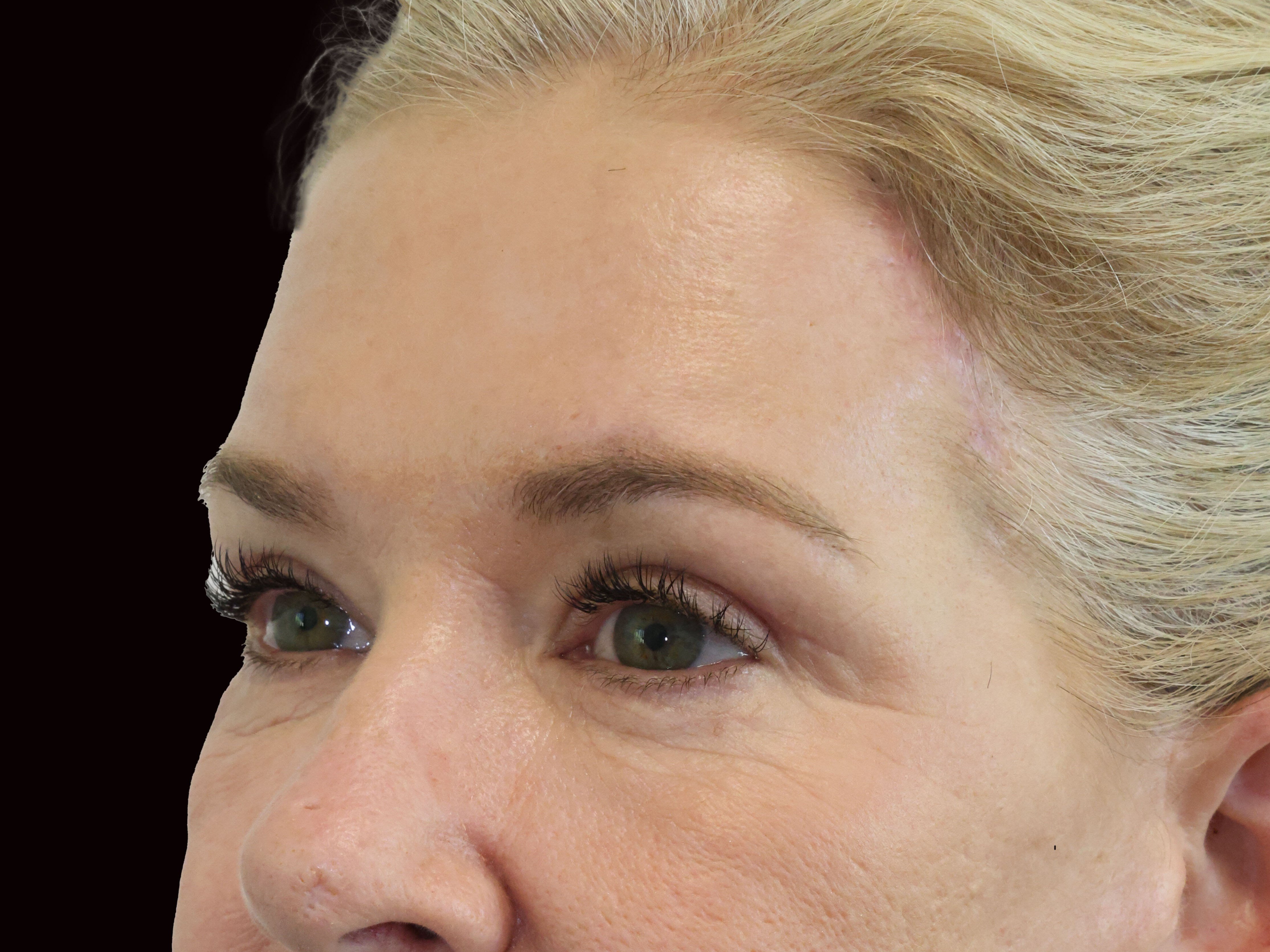 Upper and Lower Eye Bleph After