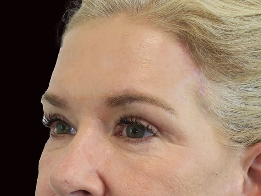 Upper and Lower Eye Bleph After