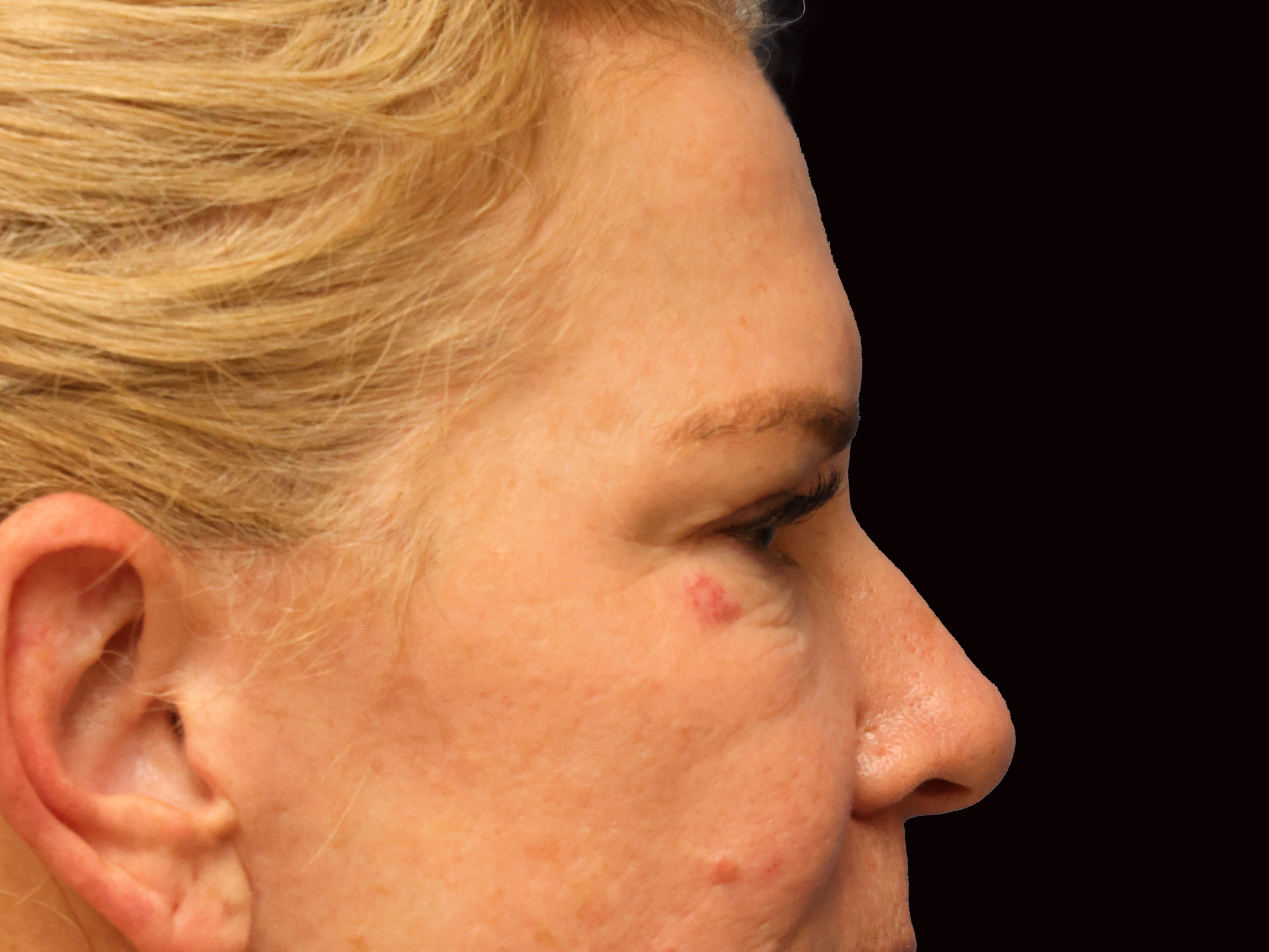 Upper and Lower Eye Bleph Before