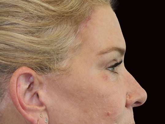 Upper and Lower Eye Bleph After