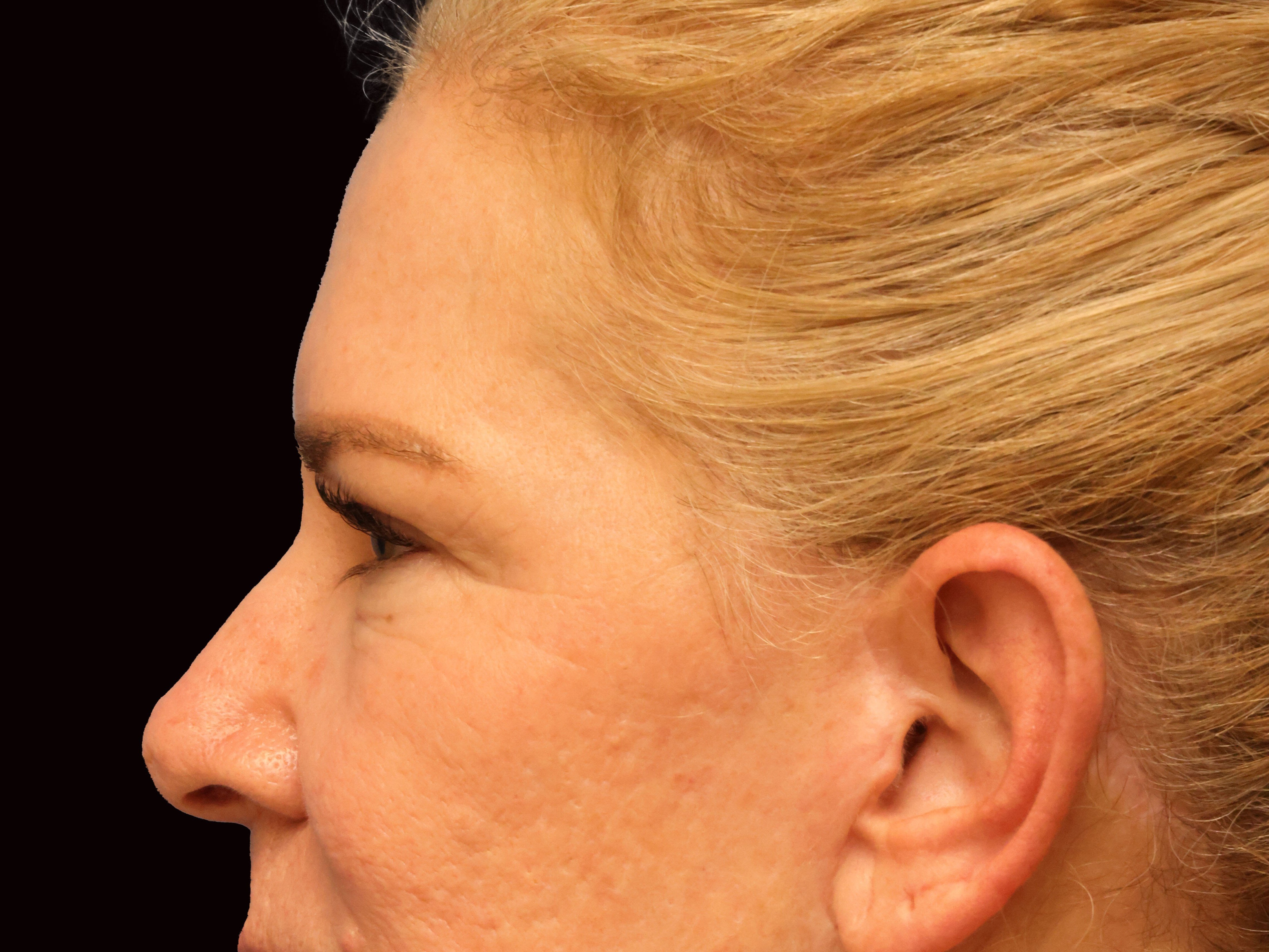 Upper and Lower Eye Blepharopl Before