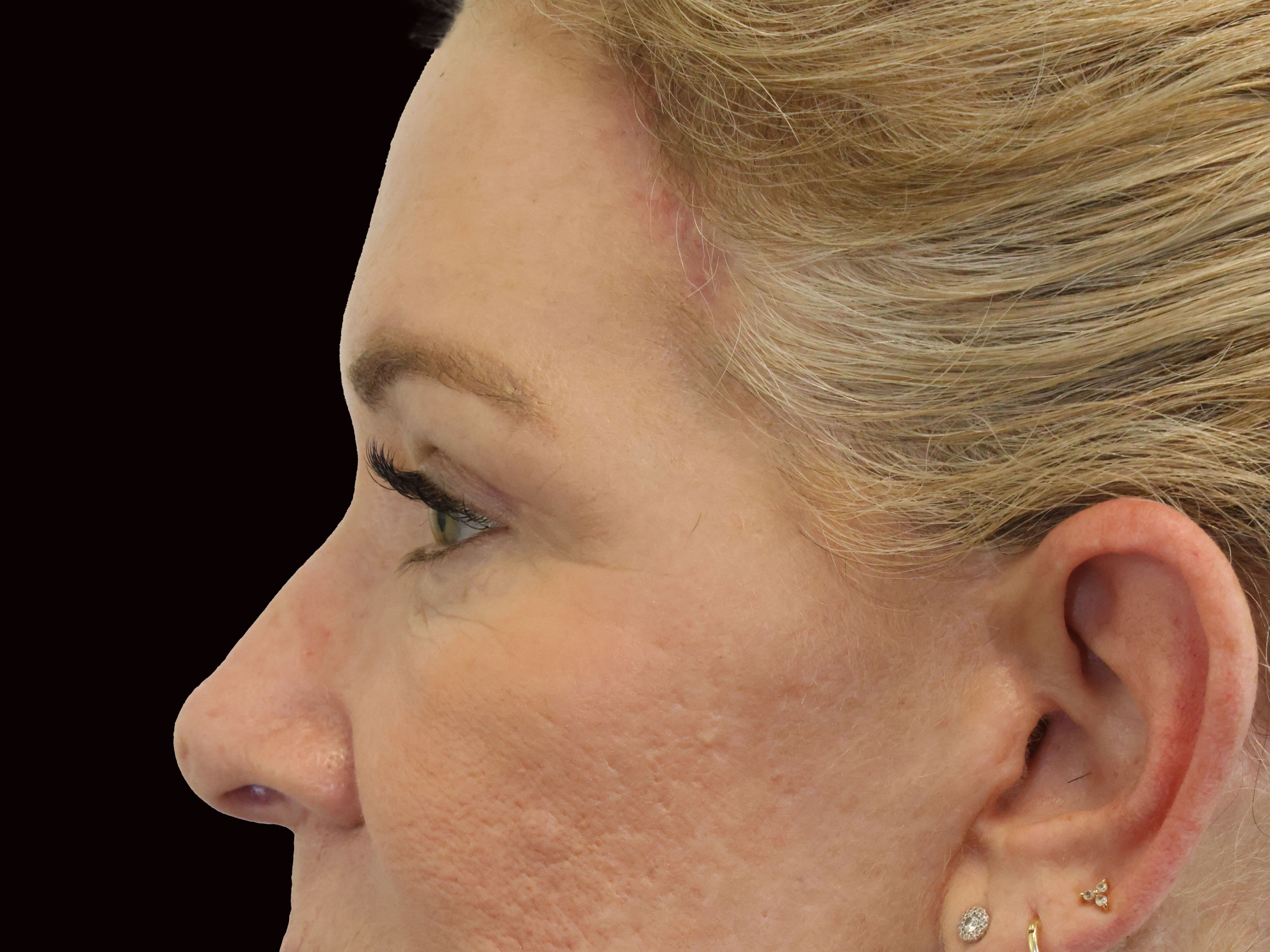 Upper and Lower Eye Blepharopl After