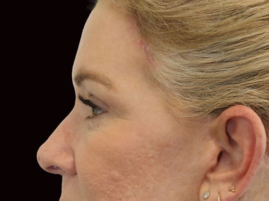 Upper and Lower Eye Blepharopl After