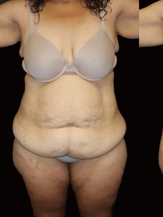 Tummy Tuck Before