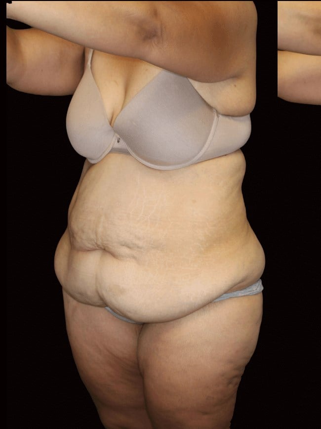 Tummy Tuck Before