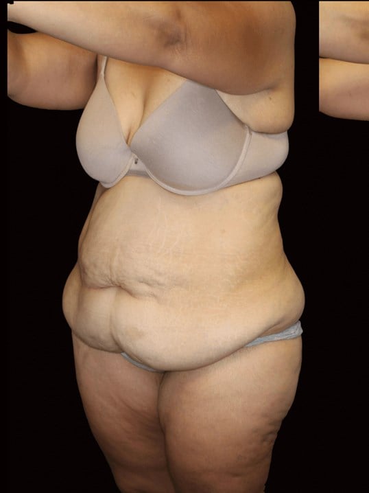 Tummy Tuck Before
