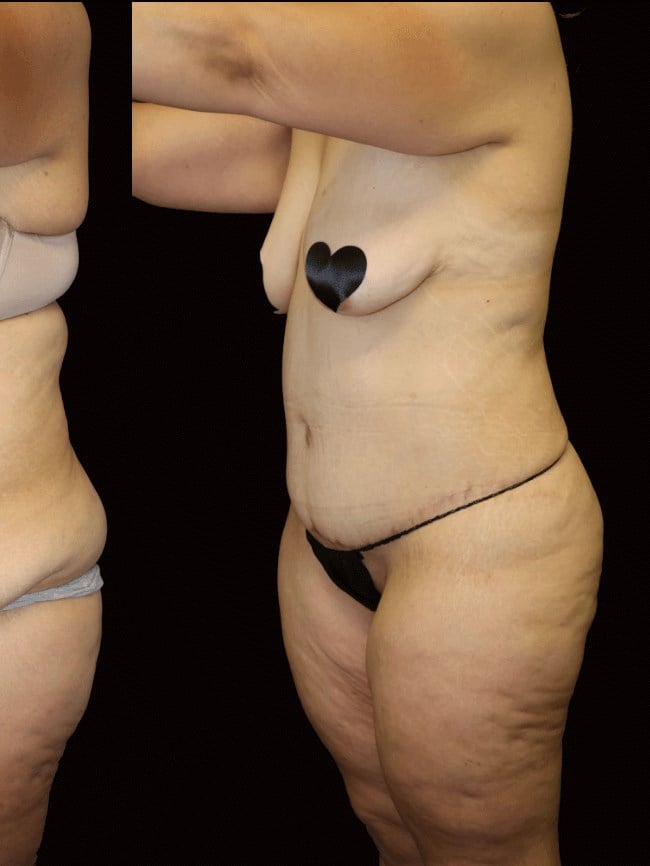 Tummy Tuck After