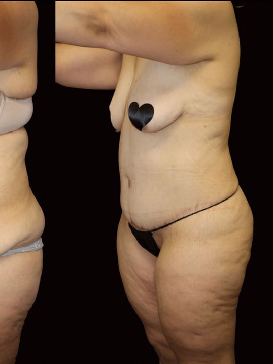 Tummy Tuck After