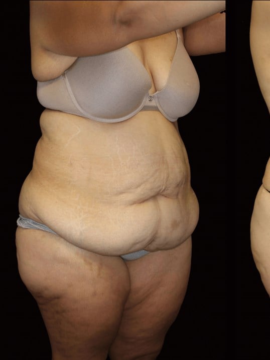 Tummy Tuck Before