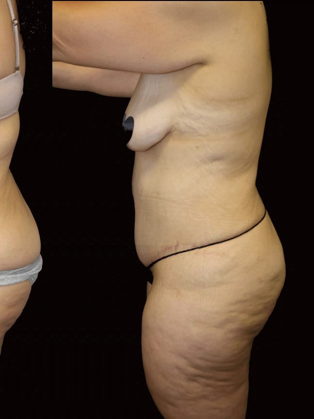 Tummy Tuck After