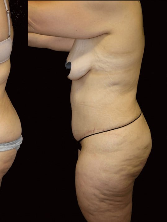 Tummy Tuck After