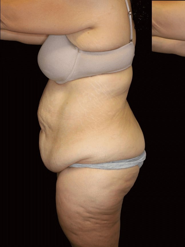 Tummy Tuck Before