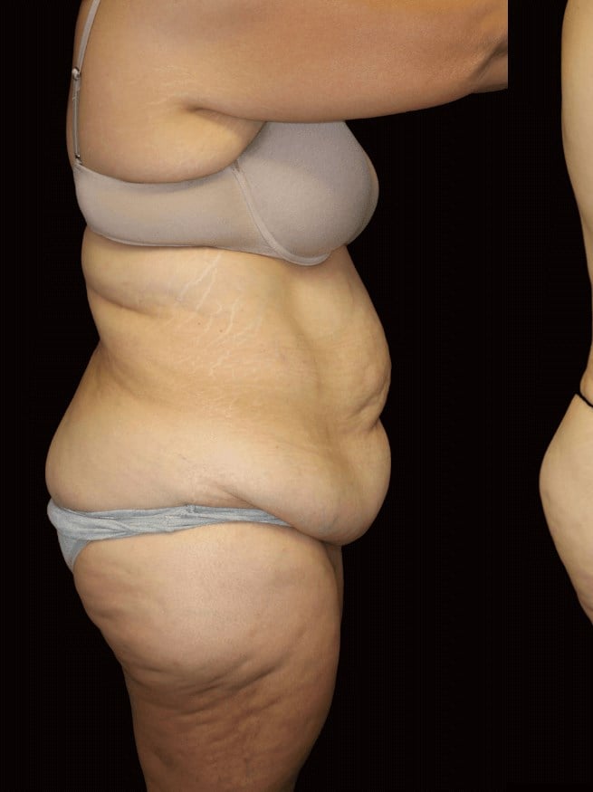 Tummy Tuck Before