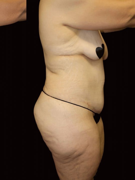 Tummy Tuck After