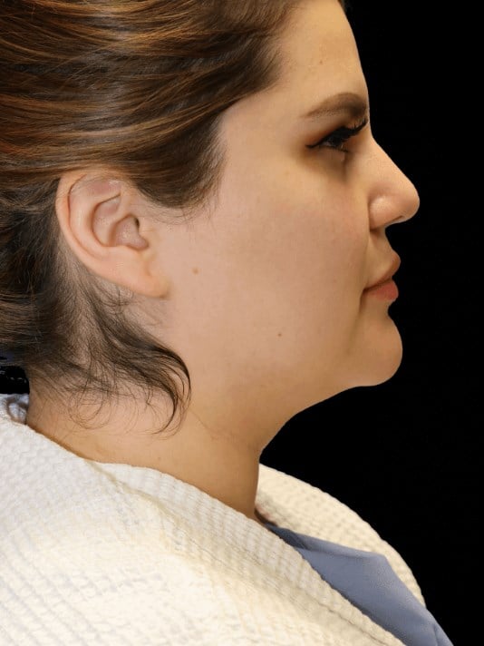 neck liposuction Before