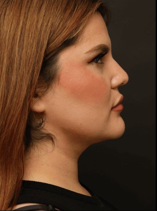 neck liposuction After