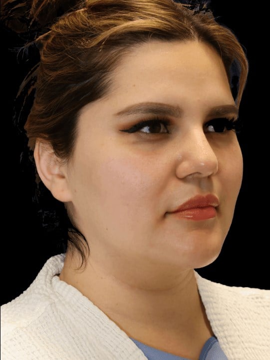 neck liposuction Before