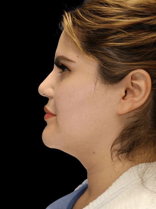 neck liposuction Before