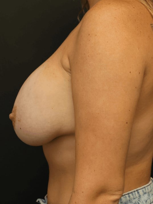Breast Lift Before