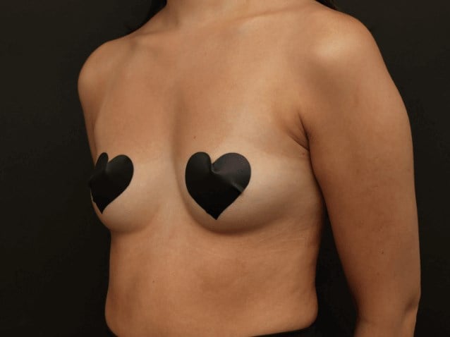 Armpit Liposuction After