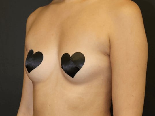 Armpit Liposuction Before