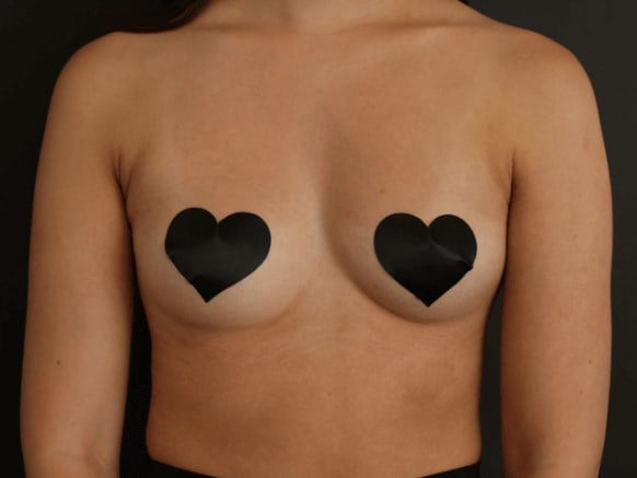 Armpit Liposuction After