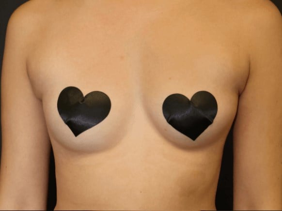 Armpit Liposuction Before