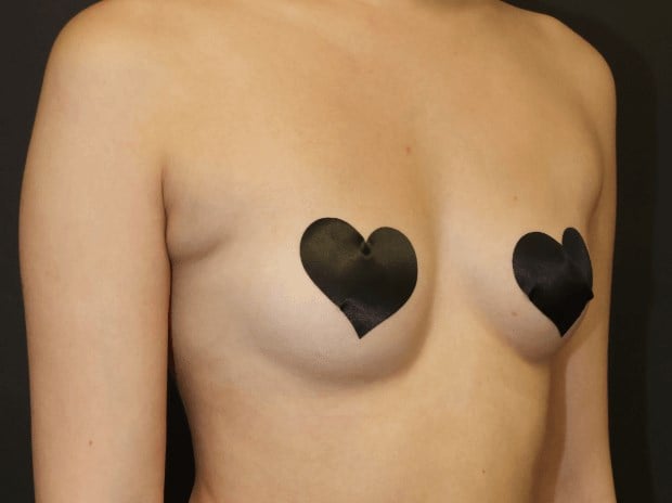 Armpit Liposuction Before