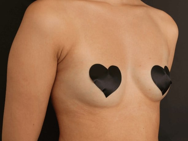 Armpit Liposuction After